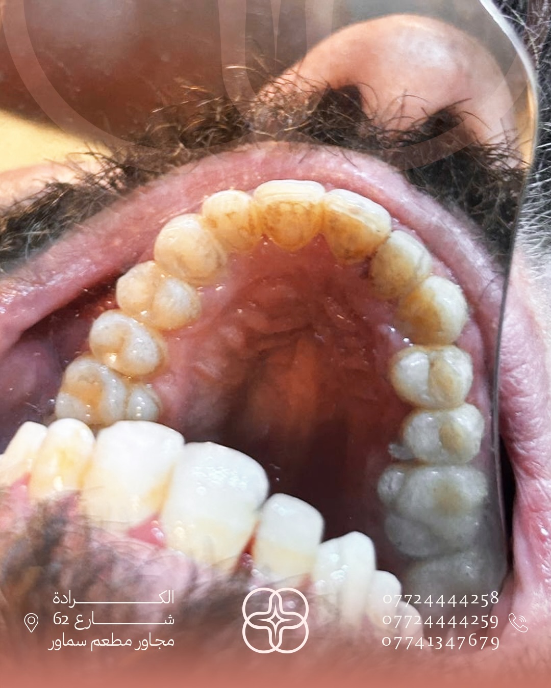 تقويم الأسنان